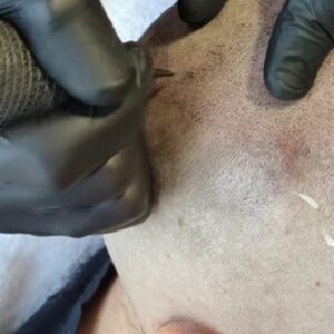 Vigoplan | Micropigmentación Capilar En Vigo